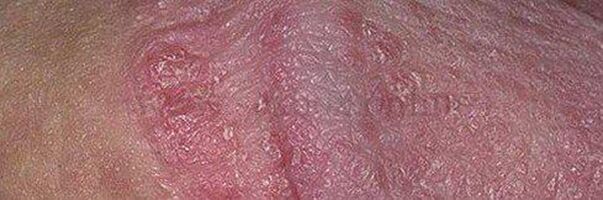 After using baking soda, dry skin and ulcers on the head of the penis