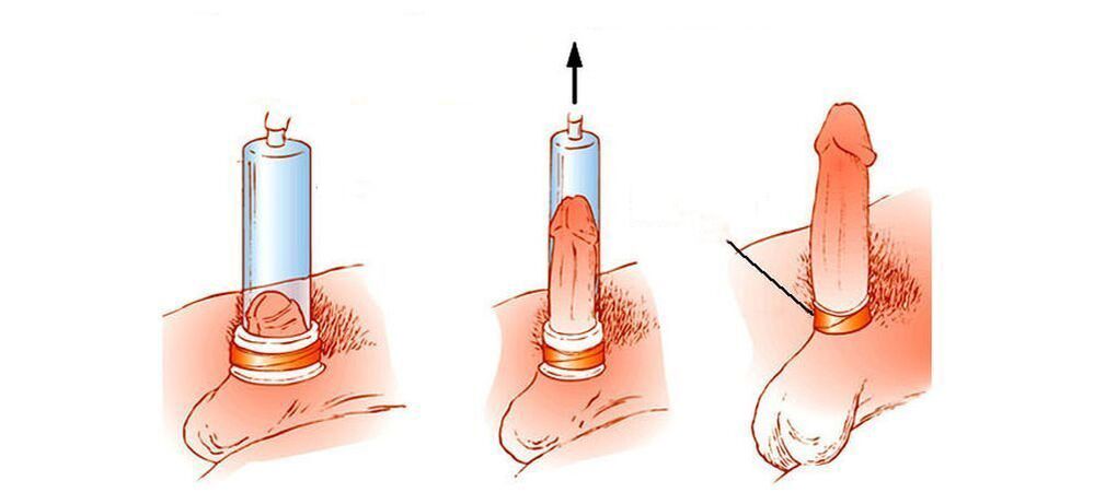 How does a penis vacuum pump work