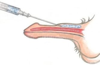 A dangerous way to enlarge the penis by injecting Vaseline.